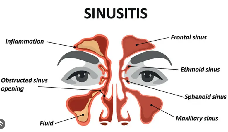Gejala penyakit sinusitis sama bersama dengan gejala pilek. Biasanya Kamu akan mengalami hidung tersumbat disertai adanya ingus atau lendir. T